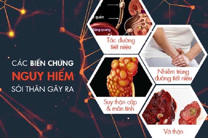 nhat-nam-tieu-thach-khang-dac-tri-soi-than-co-tot-khong nhất nam tiêu thạch khang đặc trị sỏi thận có tốt không